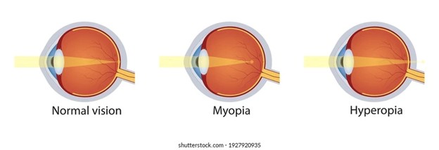 How light focuses in Myopia and Hyperopia