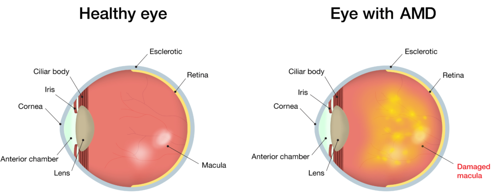 Diagram showing Age-Related Macular Degeneration